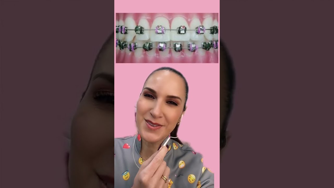 Watch Now Escolha as melhores cores de borrachinha para aparelho fixo Escolha as melhores cores de borrachinha para aparelho fixo