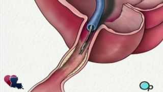 preview picture of video 'Balloon Angioplasty Coronary Angioplasty Surgery'