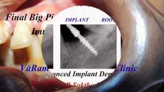 preview picture of video 'Implant and Root canal Combo-VaRam Dental Virudhunagar'