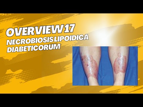 Overview 17 : Necrobiosis lipoidica diabeticorum