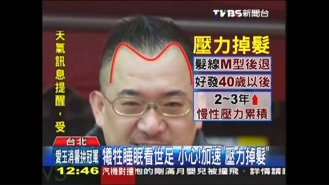 前主播改行壓力大 帥髮落成「M型禿」