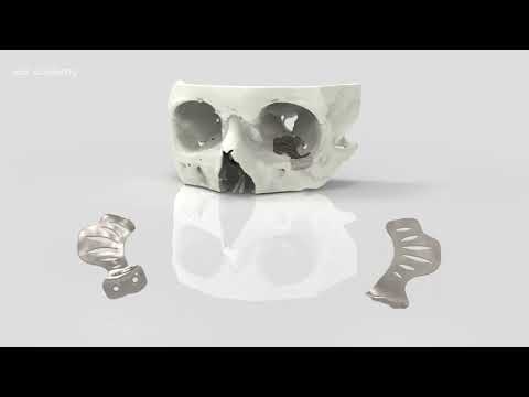 Orbital Floor Implant Design | Maxillofacial | Geomagic Freeform | Materialise Mimics | SPD Academy