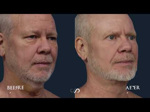 Traceless Neck lift On a 58-year-old Man | Before and After Video | Dr. David Stoker