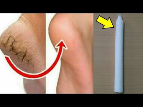 Ce este artroza displazică a genunchiului