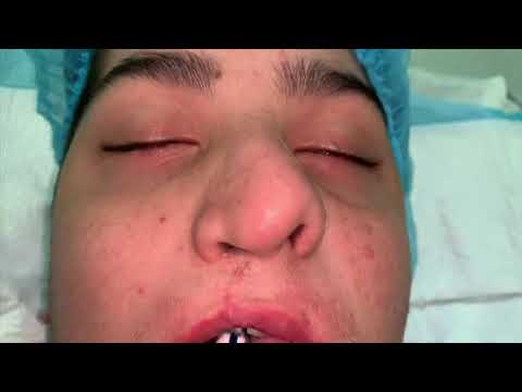 Cleft Rhinoplasty