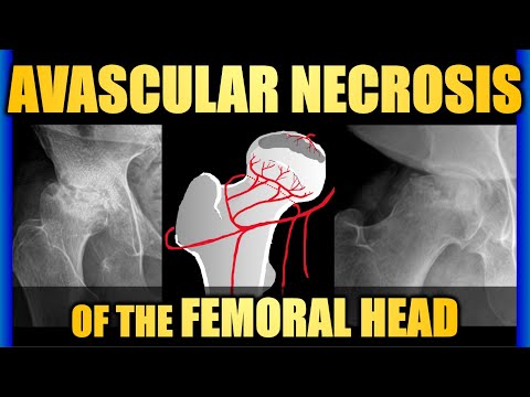 Avascular Necrosis of the Femoral Head #hippain #trauma #radiology