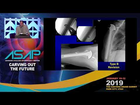 Humeral periprosthetic fractures - Non-op versus surgery