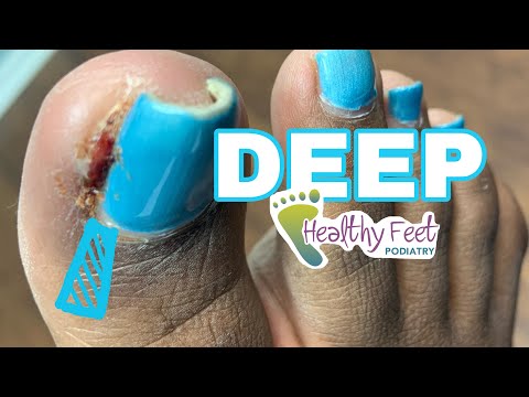 DEEPEST and LONGEST INGROWN NAIL REMOVED