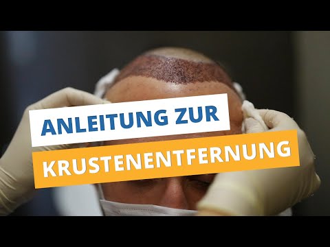 Krusten entfernen nach Haartransplantation ►Anleitung zur Krustenentfernung ◄