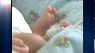 Palm-Sized Baby with Walnut Sized Head Beats Death