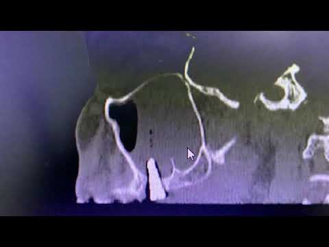 Dental implants inside the maxillary sinus - Oral surgery gone wrong!