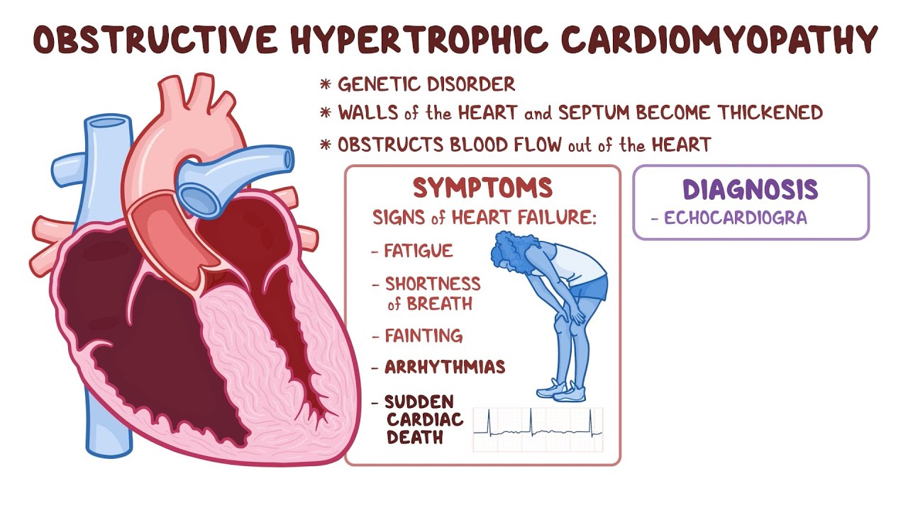 Hypertrophic Cardiomyopathy Explained: Symptoms, Causes & Treatments