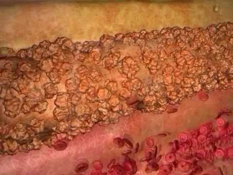 Diagnosetest für Prostatakrebs Rosskastanie in der Behandlung von Prostatitis