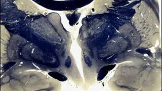 Doctor Brain Anterior Nucleus Of Thalamus