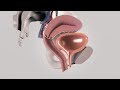 Total Laparoscopic Hysterectomy