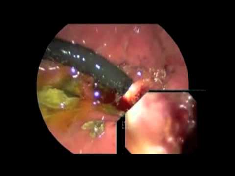 Endoscopic-Guided Transgastric Laparoscopic Retrieval of a Duodenal Stent