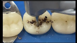 UFMA.Preparo Cavitário e Restauração de Resina Composta_Dente Posterior (Classe I)