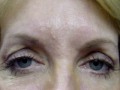 Botox Treatment at best Price in Orange County at Dr Weiss