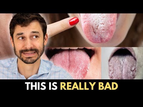 Die seltsamste Zungendiagnose (und was sie bedeutet)