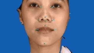 preview picture of video 'Han Quoc (Korean) 3D nose in Sai gon | Han Quoc Aesthetic Surgery Center'