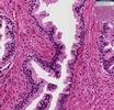 Kirsche von Prostatitis Zeitergebnisse einer Biopsie der Prostata