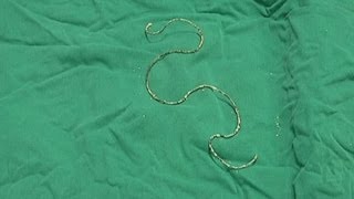 Surgery for man who used his earphone cable as a catheter