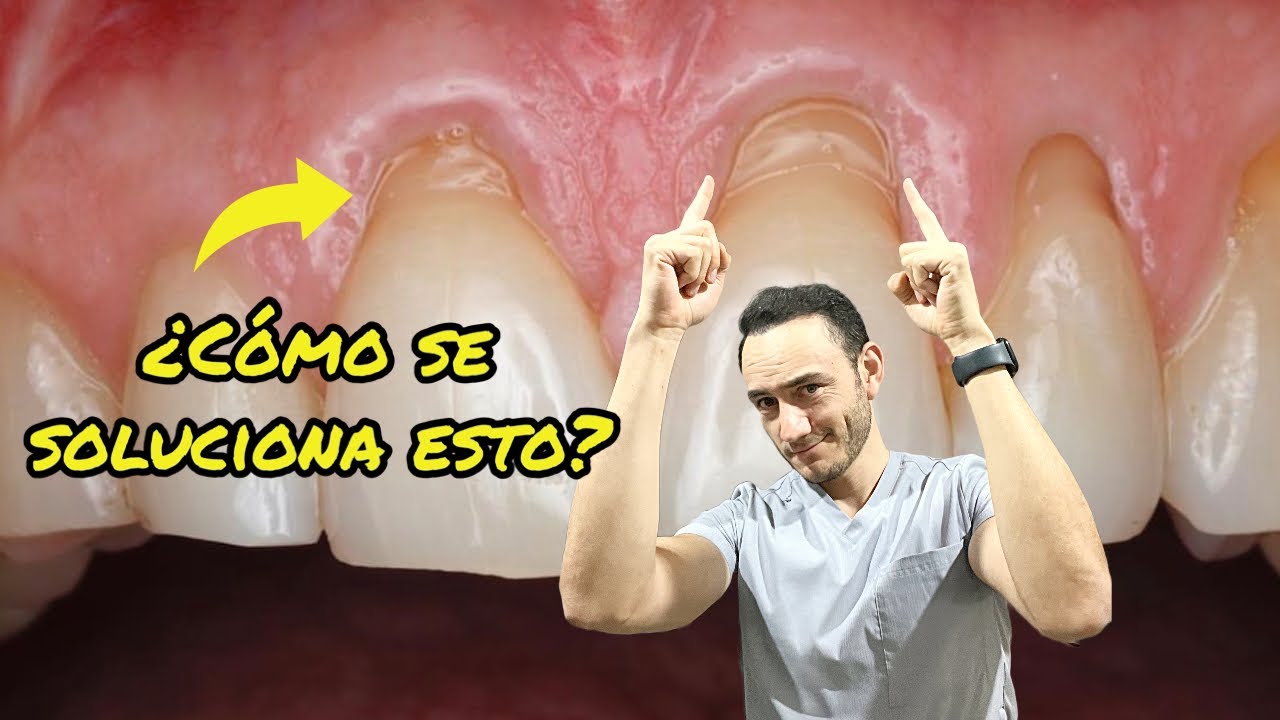 Watch Así se solucionan las encías retraídas (recesión gingival) Now Así se solucionan las encías retraídas (recesión gingival)