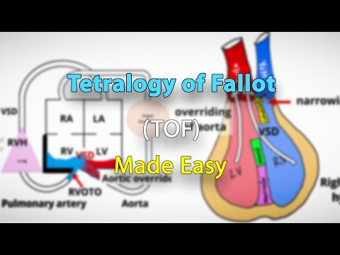 Tetralogy of Fallot (TOF) anatomy, pathophysiology, clinical features and diagnosis | Made easy