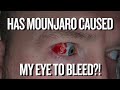 MOUNJARO: WHY IS MY EYE BLEEDING?!