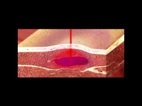 Osteocondrosi del ginocchio nei sintomi e le cause per bambini Che i muscoli in osteocondrosi