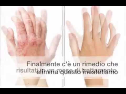 Quello che è se i capelli a psoriasi abbandonano Psoriasi su un labbro di fotografia