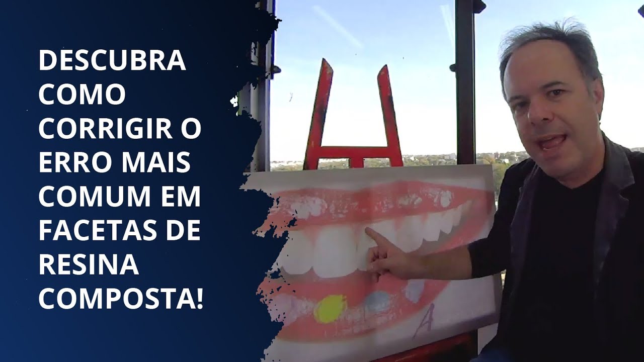 Descubra como corrigir o ERRO MAIS COMUM em facetas de RESINA COMPOSTA | LENTES DIRETAS®