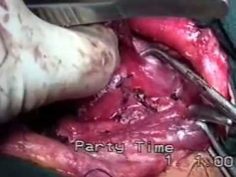 Central Compartment Neck Dissection For Thyroid Cancer