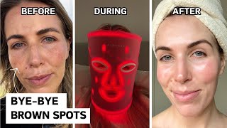 How I got rid of my melasma - cosmelan peel review