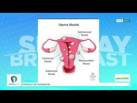 Fibroids: What Every Woman Should Know About These Common Growths | Sunday Breakfast