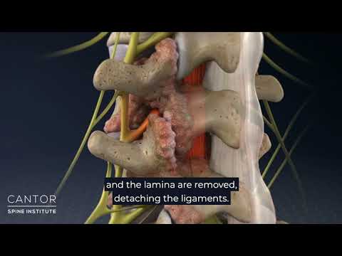 What is Ultrasonic Laminaplasty?