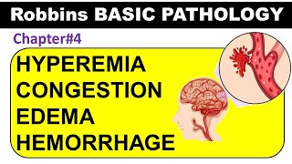 Chp4 (Part1) Robbins Basic Patho | Hyperemia | Congestion | Edema | Hemorrhage | General Pathology