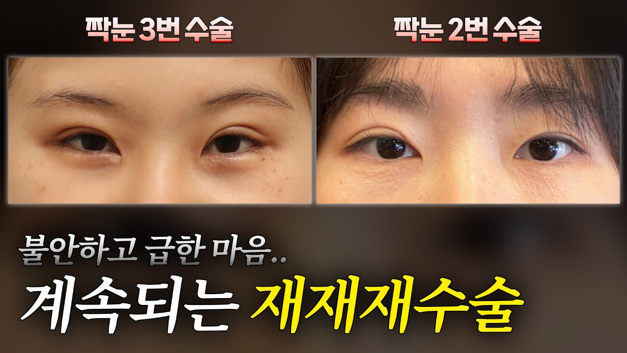 마음은 급하고 재수술은 해야겠고..그런데 짝눈은 계속 그대로?... 썸네일 — 마침표성형외과 눈성형 영상