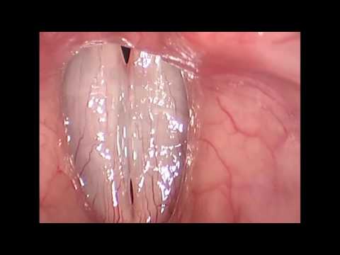 Rigid Stroboscopy Clinical Video