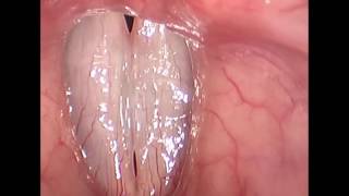 Rigid Stroboscopy Clinical Video
