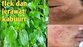 Download lagu embarrassed to have stubborn acne, let's treat it naturally mp3 Download lagu embarrassed to have stubborn acne, let's treat it naturally mp3