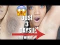 Watch How I Lighten and Get Rid Of My Dark Armpits FAST!! Before and After Results.