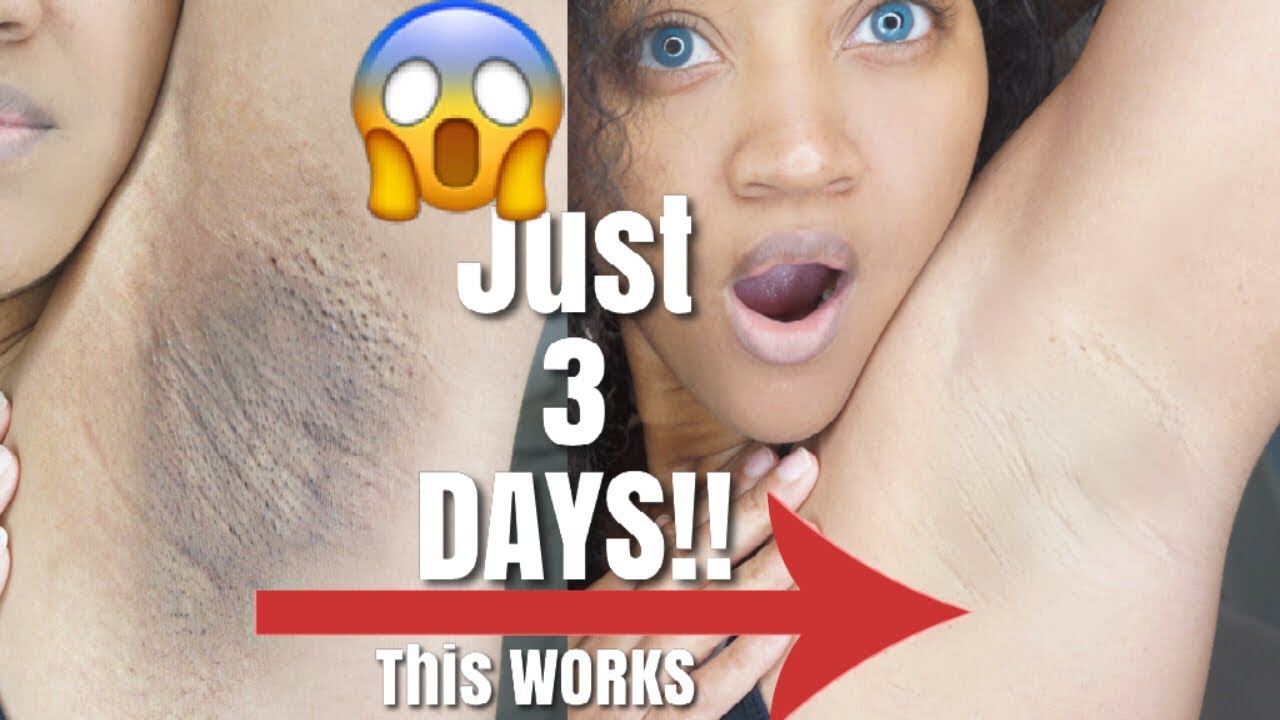 Watch How I Lighten and Get Rid Of My Dark Armpits FAST!! Before and After Results.