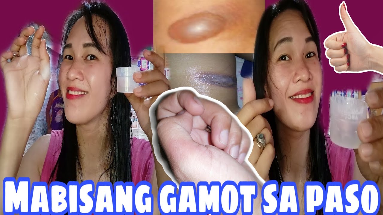Mabisang gamot sa paso
