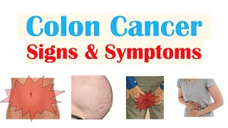 Colon Cancer (CRC) Signs & Symptoms (& Why They Occur)