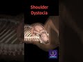 Baby Stuck During Birth Shoulder Dystocia Shorts Pregnancy Youtubeshorts