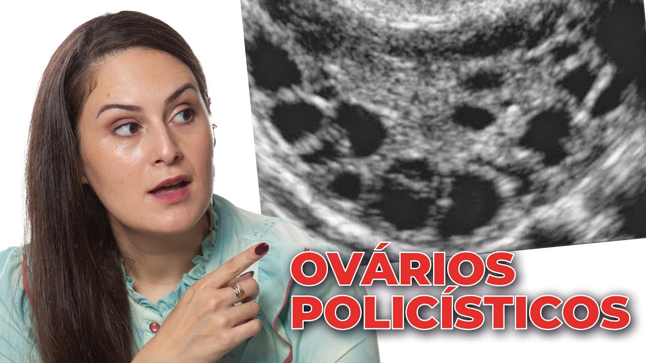 Tudo sobre a Síndrome de Ovário Policístico - SOP