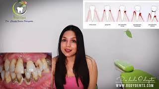 Como se forma el calculo dental - Claudia Vanesa Ordosgoitia