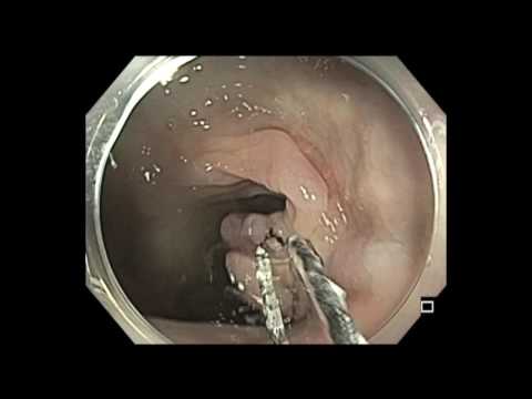 Colonoscopy: Splenic Flexure Polyp Resection Using Water Float Technique
