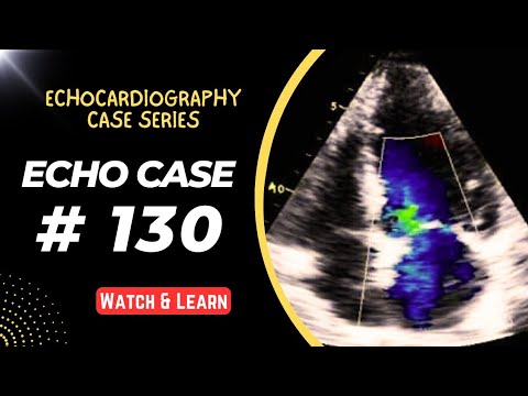 ECHO CASE 130: Echocardiography Spot Diagnosis Series - Calculate Left Atrial Pressure (LAP)